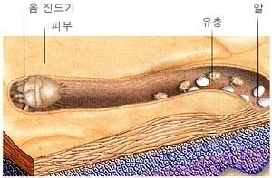 서울 아산병원 옴진드기